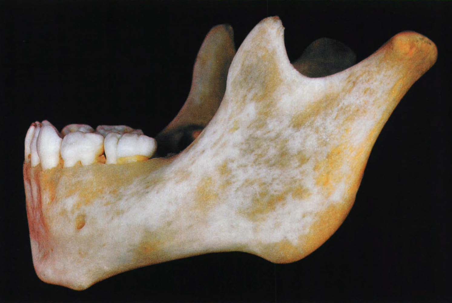 51. 由幼至老下颌骨形态的改变 (2)